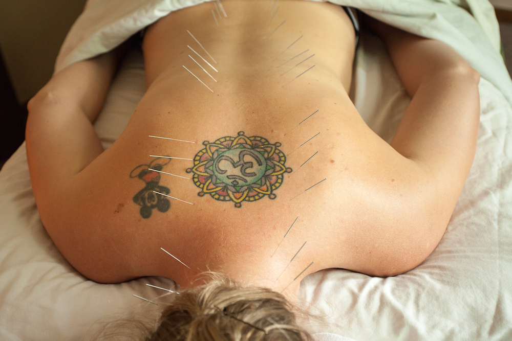 Woman laying facedown on massage table with acupuncture needles in her back. Women's health.