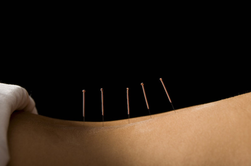 Acupuncture services